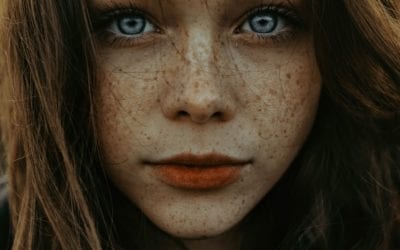 Freckles and Pigmentation